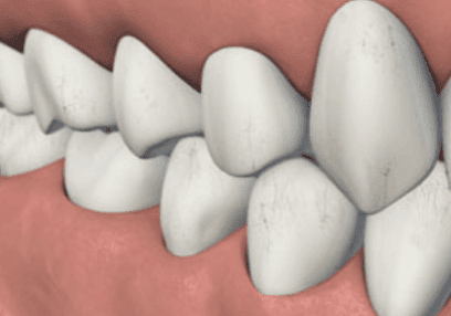 Grinding teeth can cause 'craze lines' and more